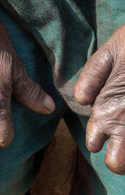 World Leprosy Day 2019: Expert Says Why It’s Dangerous To ‘Cure’ Leprosy With Alternative Medicine World Leprosy Day 2019: Expert Says Why It’s Dangerous To ‘Cure’ Leprosy With Alternative Medicine